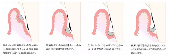 歯垢除去と処置
